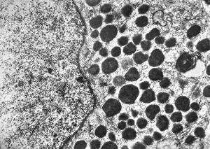 M, 23y. | acidophilic pituitary adenoma (STH) M, 23y. | acidophilic pituitary adenoma (STH)